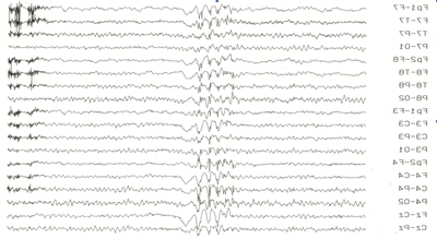 脑电图(EEG)